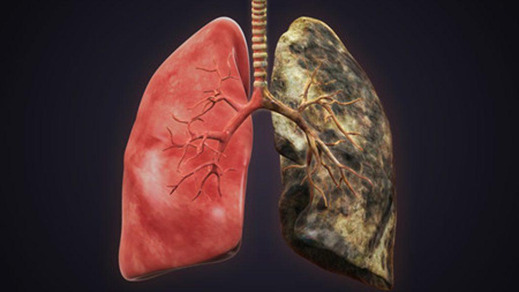 Pulmón sano y pulmón afectado por EPOC
